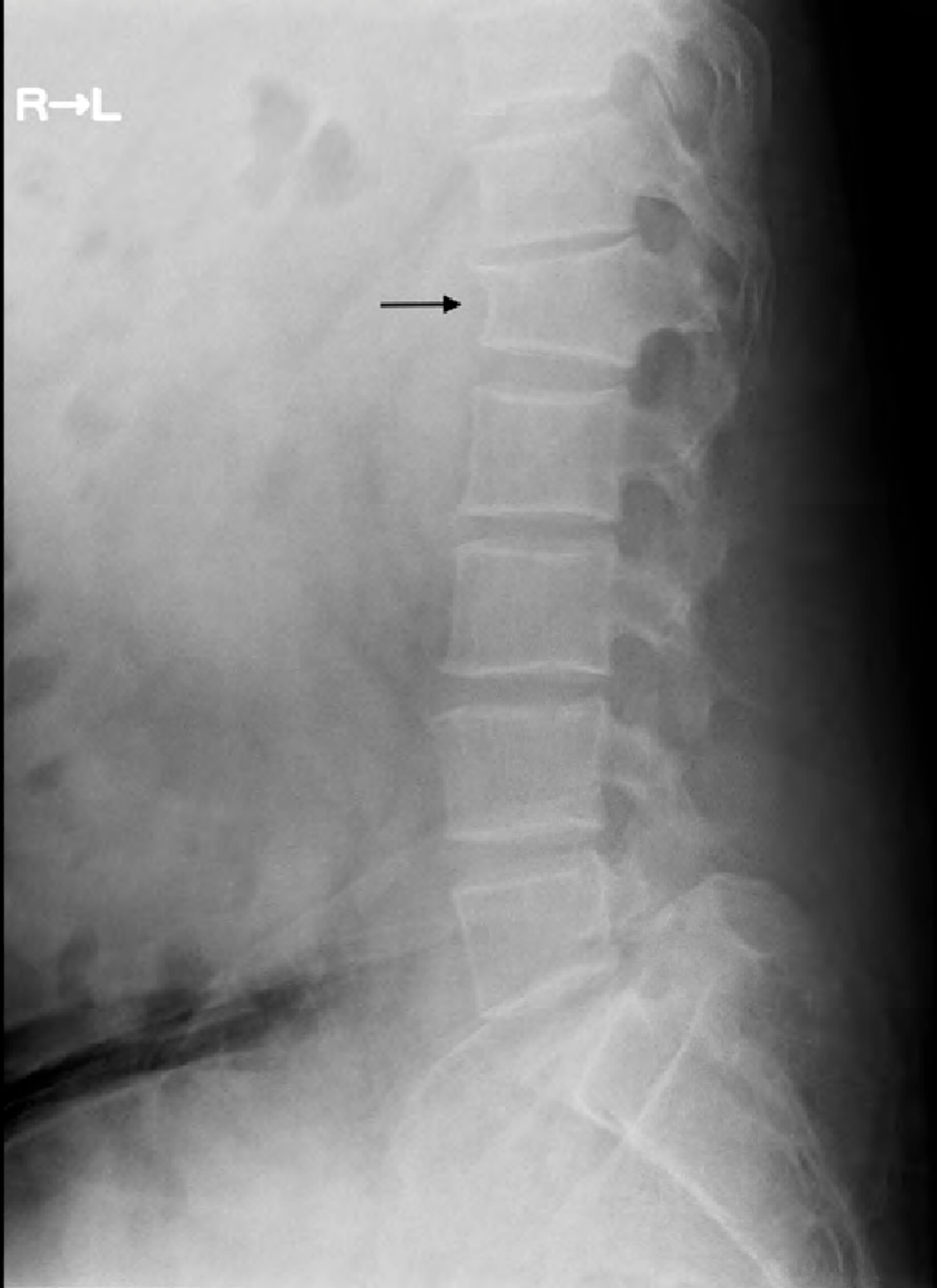 x-ray, compression fracture